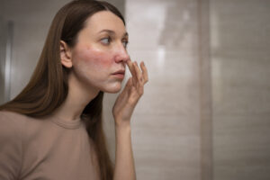 woman looking at her Seborrheic Dermatitis symptoms mirror.