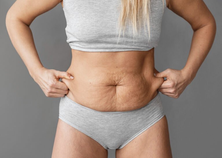woman trying to tighten loose skin | 7 Ways to Avoid Loose Skin After Weight Loss