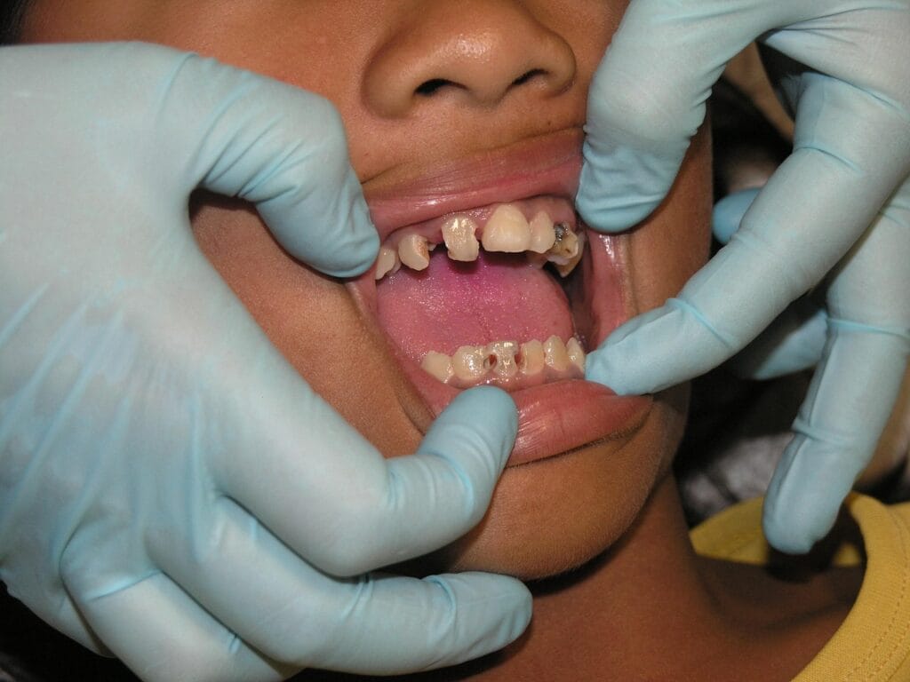 bad teeth, toothache, dental treatment, bad teeth, bad teeth, bad teeth, bad teeth, bad teeth, toothache, toothache