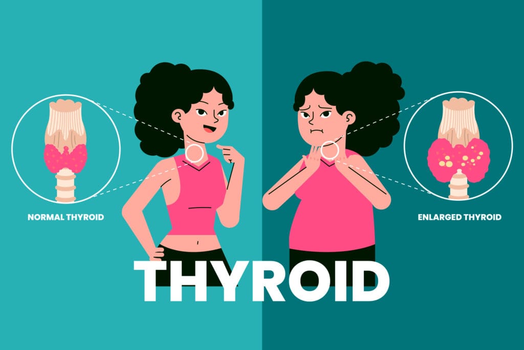 thyroid illustration